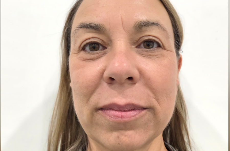 Photo après le traitement XERF